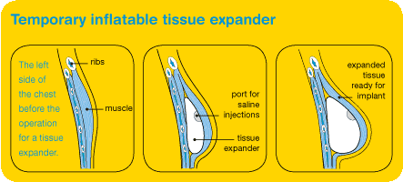 Temporary inflatable breast tissue expander