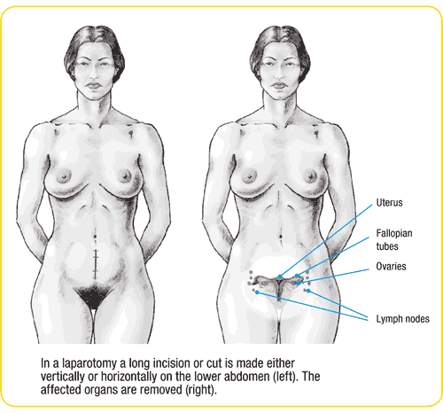 Diagram of a laparotomy incision