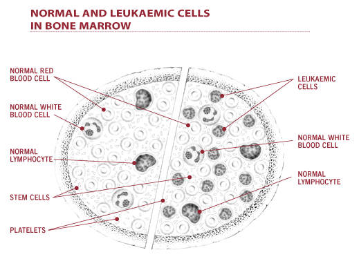 leukemia bone marrow. leukemia bone marrow. cells in one marrow