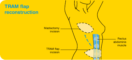 TRAM flap breast reconstruction