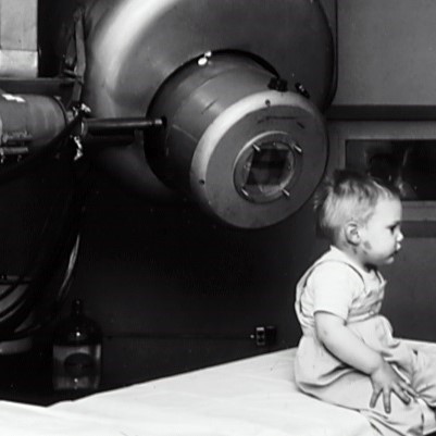Childhood radiation therapy in 1957 - Gordon Isaacs is the first patient for treatment for retinoblastoma