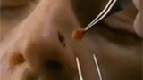 A skin cancer is cut from a nose