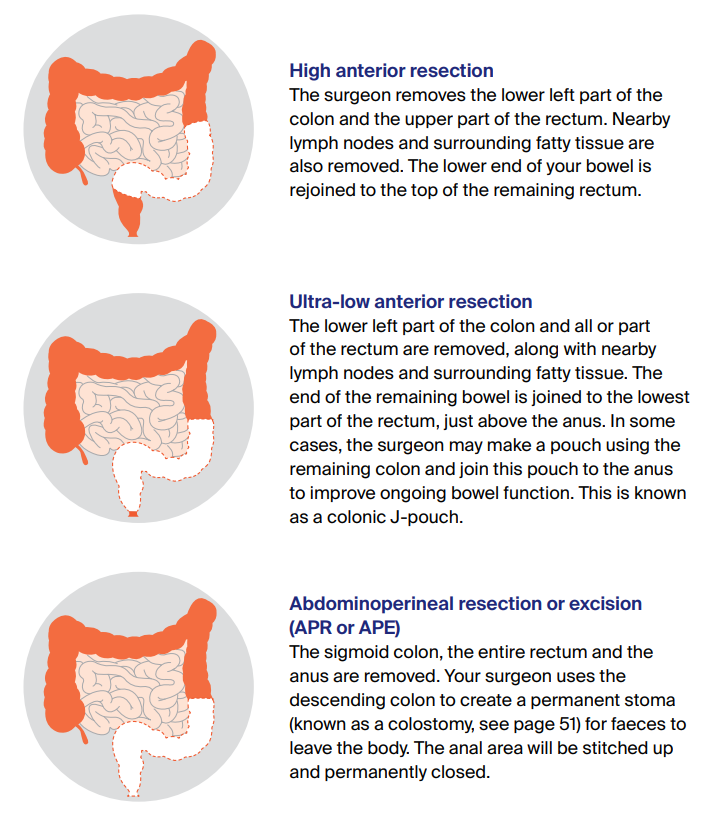Types of resections Diagram showing types of resections for rectal cancer.