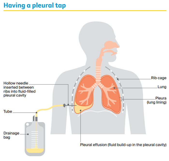 Diagram of how a pleural tap is done.