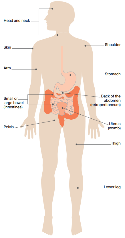 Where are soft tissue sarcomas found? Diagram of the places on the body where soft tissue sarcomas can be found.