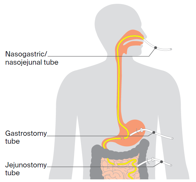 Having a feeding tube
