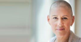 Woman with hair loss due to cancer