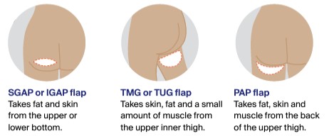 Sgap Breast reconstruction