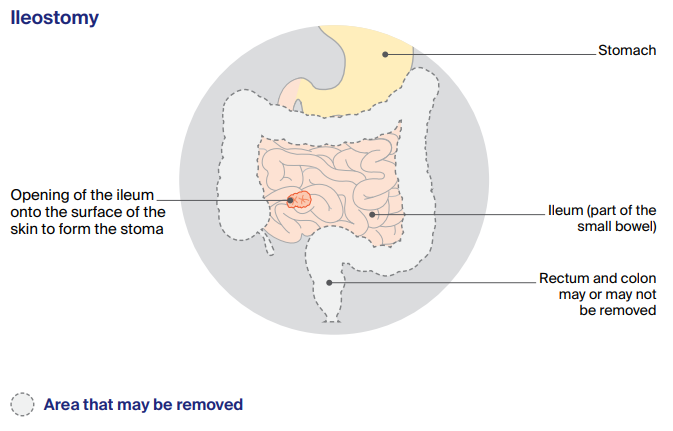Description of a ileostomy with images and text
