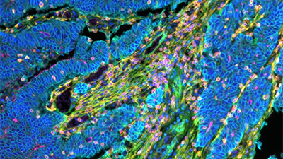 image of tumour