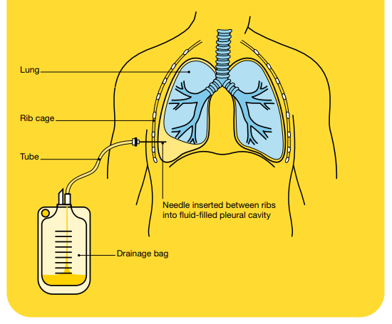 can small cell lung cancer be caused by asbestos