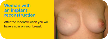Woman with an implant reconstruction