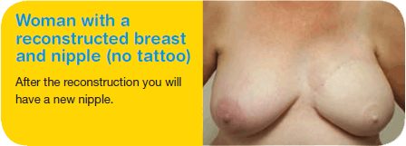 Woman with a reconstructed breast and nipple (no tattoo)