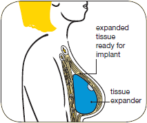 Stages of delayed breast reconstruction with a tissue expander
