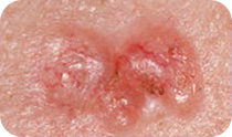 Basal cell carcinoma – pearl-coloured nodule or lump
