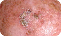 Squamous cell carcinoma – thickened scaly nodule or lump
