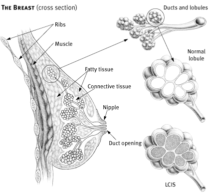 lobular carcinoma in situ